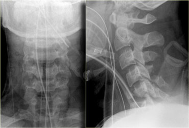 Flexion tear drop fracture due to diving injury