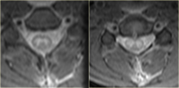 Central spinal cord injury