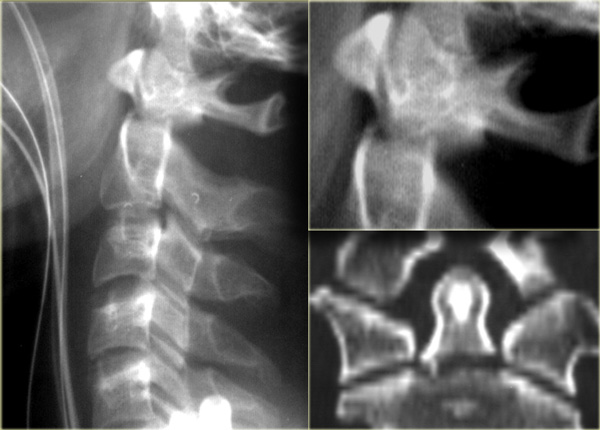 Odontoid fracture type II