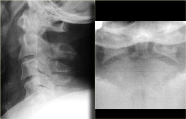 Odontoid fracture type II