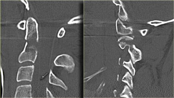 Odontoid fracture type III