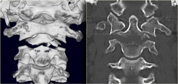 Type III odontoid fracture