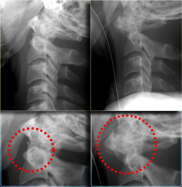 Unstable type II odontoid fracture