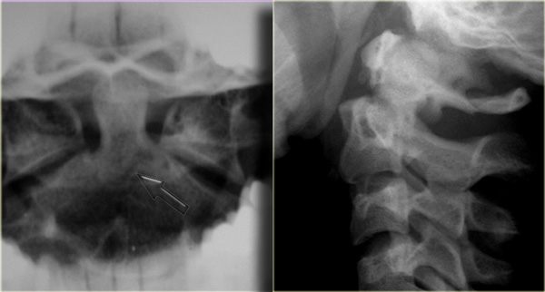 Unstable type III odontoid fracture