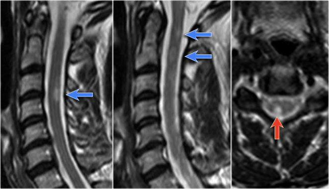 Acute exacerbation of cerebral and spinal MS