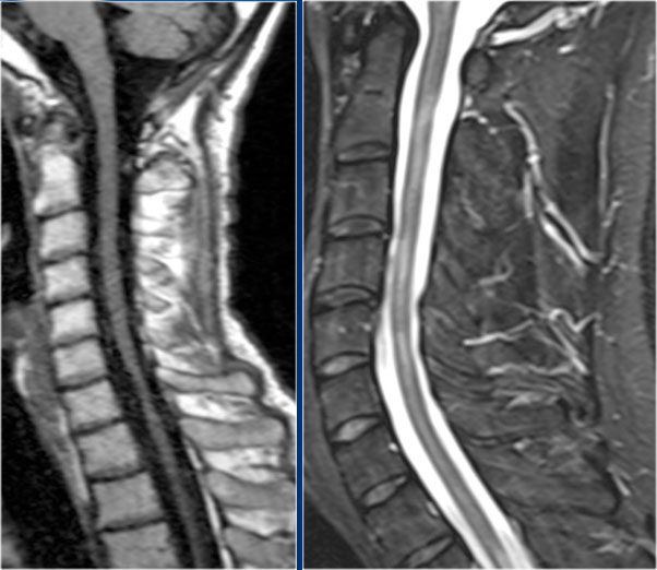 Atrophy in longstanding MS