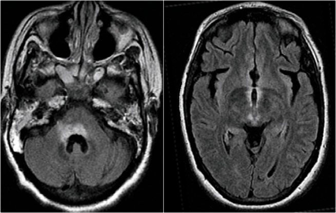 Periventricular lesions in NMO around fourth and third ventricle.