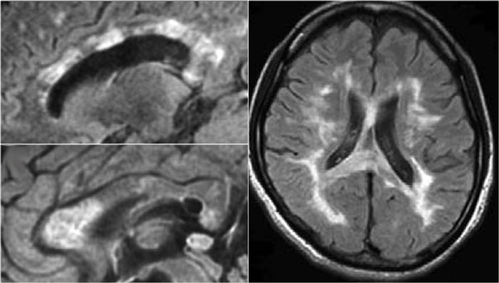 Neuromyelitis optica with callosal lesions. Courtesy Dr Nakamura.