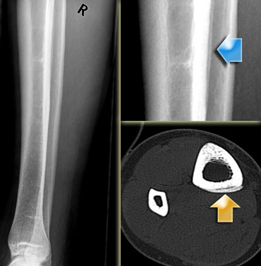 X-ray and CT-scan showing a fissure at the insertion of the flexor digitorum longus muscle. Courtesy Dr Wuisman (3)