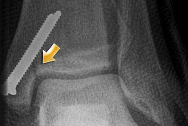 Post operative radiograph