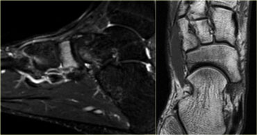 Grade 3 stress fracture of the tarsal navicular bone.