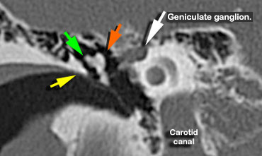 Scutum (yellow arrow). Head of malleus (orange arrow) is seen medial to the incus (green arrow)