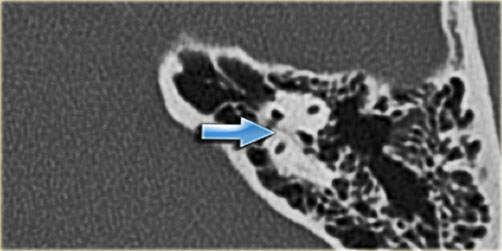 Petromastoid canal