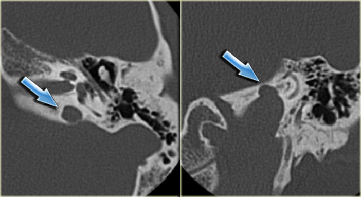 Jugular bulb diverticulum: axial and coronal image