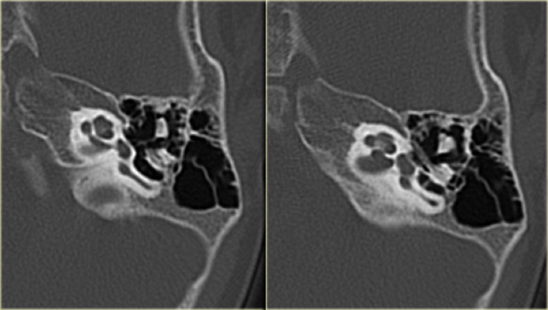 External auditory canal atresia