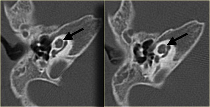 Minor cochlear deformity