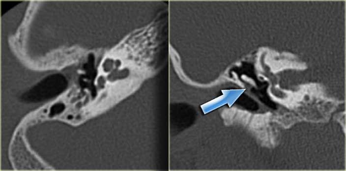 Chronic otitis media