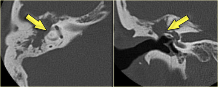 Cholesteatoma with erosion of the wall of the lateral semicircular canal