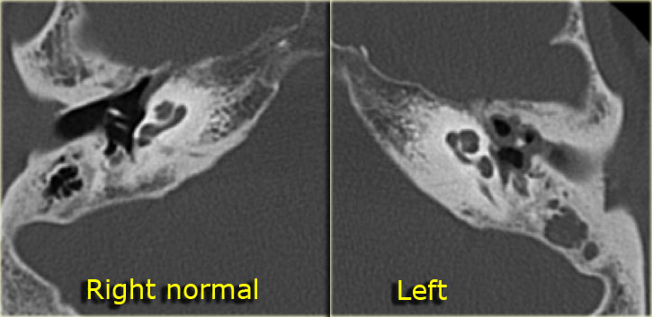 Chronic mastoiditis. No cholesteatoma.