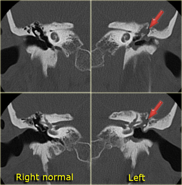 Chronic mastoiditis. No cholesteatoma.