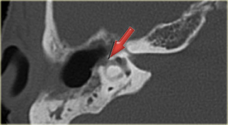 Cholesteatoma with fistula to the lateral semicircular canal (arrow)