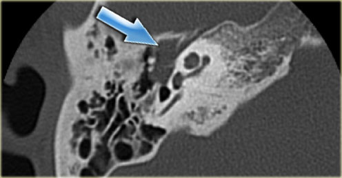 Cholesteatoma with lateral displacement of the incus with erosion of its lenticular process and of the stapes