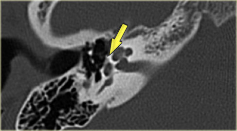 Otosclerosis anteriorly to the oval window (arrow)