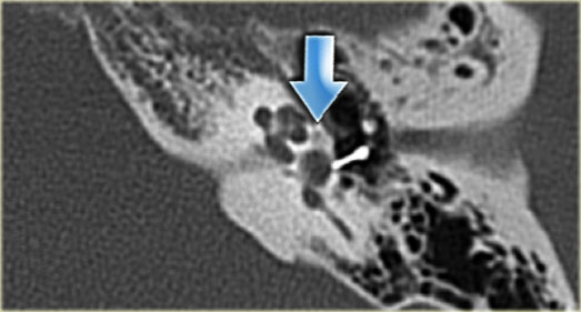 Metallic stapedial prosthesis. Lucency between vestibule and cochlea as a manifestation of otosclerosis (arrow)