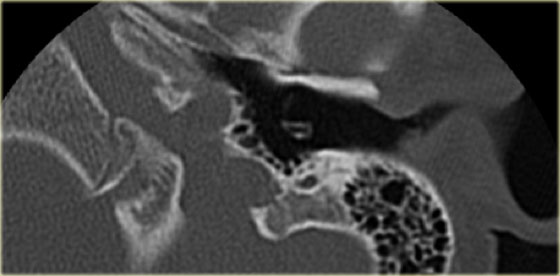 4 year old boy with recurrent otitis.  The tube is in good position