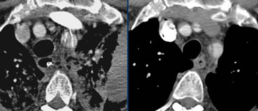 Type A dissection extending into the brachiocephalic arteries.LEFT: not visible on left arm injection.RIGHT: Same patient with right arm injection.