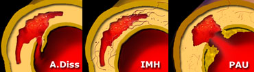 Typical Aortic Dissection,  Intramural Hematoma and Penetrating Aortic Ulcer.