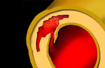 Classic Aortic Dissection