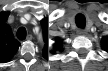 Aortic dissection involving brachiocephalic branches.