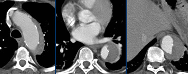 Same case. CECT of Intramural hematoma type B.