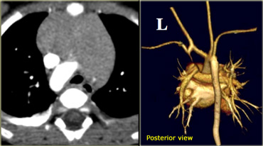 Axial image and volume rendering posterior view