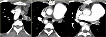 Mirror image aortic arch in patient operated for tetralogy of Fallot. 