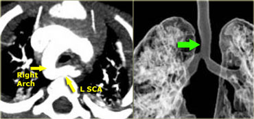 Right Arch with Aberrant left subclavian