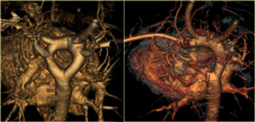 Pre- and post-operative reconstructions of a double aortic archImage courtesy of Dr. W. Chu (4)