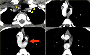 Double Arch with Atretic Segment