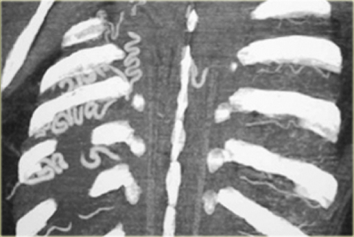 Intercostal collaterals in aortic coarctation