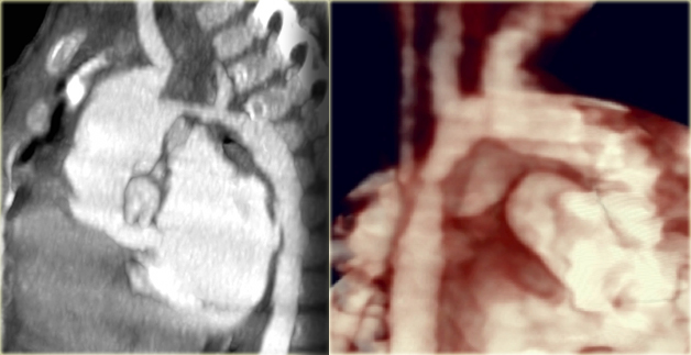 Pre-ductal type of coarctation