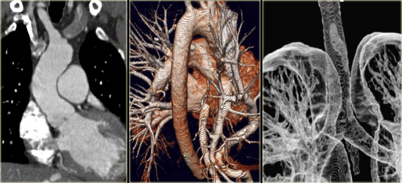 Coronal MPR (left), external volume rendering (middle) and internal volume rendering.