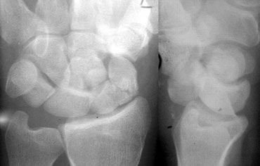 Same projection of ulna and ulnar styloid on PA and lateral view due to malpositioning in a patient with a perilunate fracture dislocation.