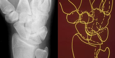 Normal oblique radiograph of the wrist and schematic representation