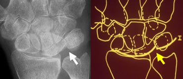 PA radiograph of the wrist and schematic representation showing disruption of the first carpal arc