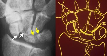 Disruption of the second carpal arc