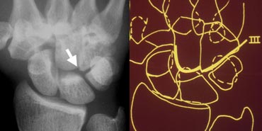 Disruption of the third carpal arc at the capitohamate joint