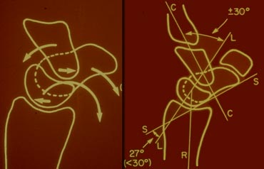 LEFT: Volar tilting of the lunate in VISIRIGHT:  Scapholunate angle is