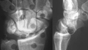 Perilunate dislocation with fracture of scaphoid and ulnar styloid processThe volar tip of lunate is also broken (see circle).