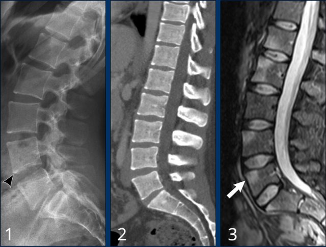 Early stage ankylosing spondylitis